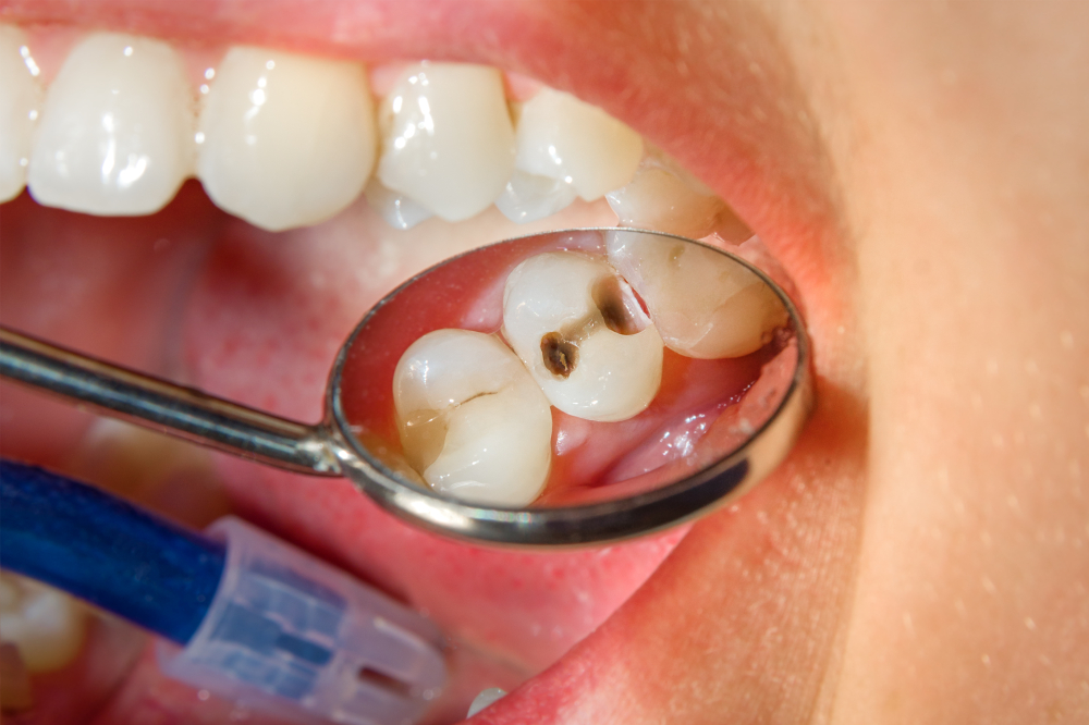 Prečo vzniká zubný kaz a ako ho liečiť?